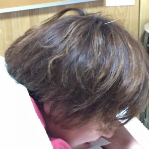 たんこぶにも鍼