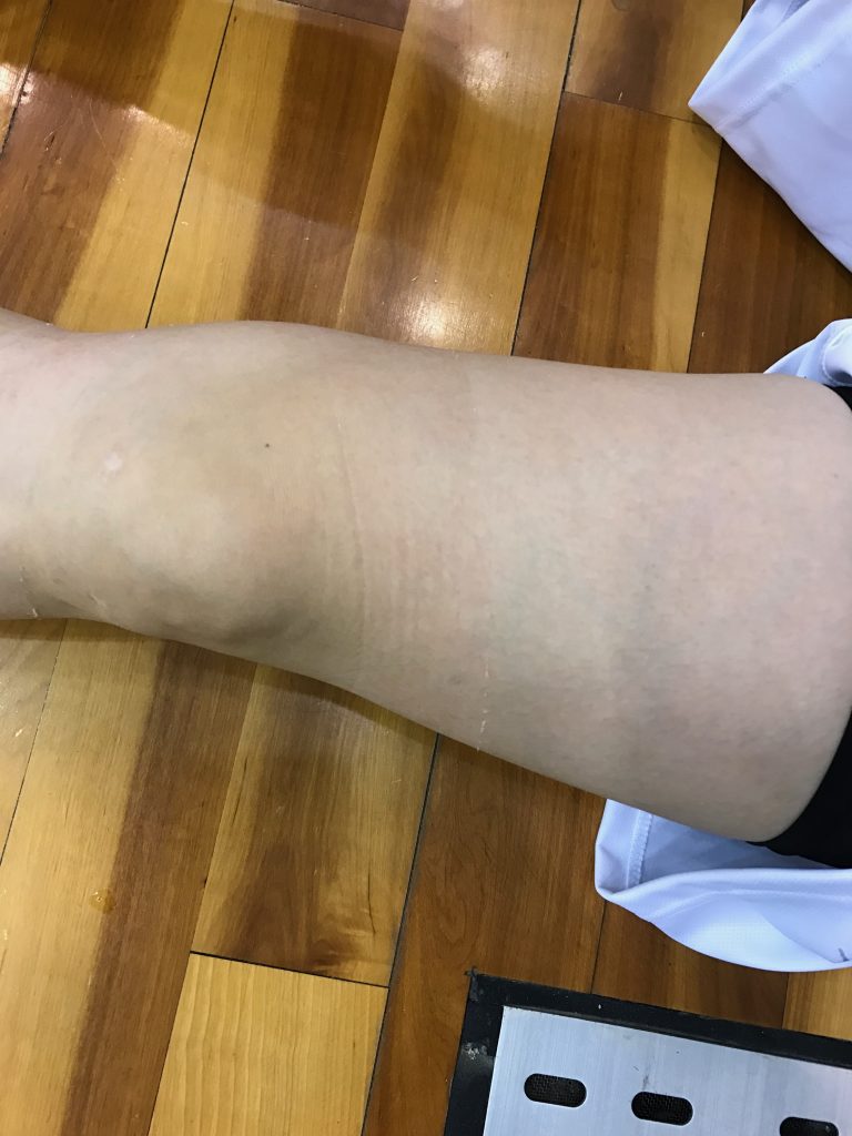 赤い跡が・・・ない。。